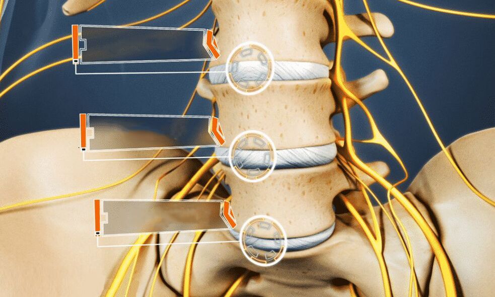 La hernia intervertebral provoca impotencia.